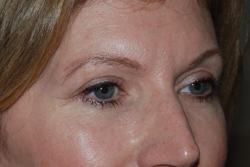 Blepharoplasty Before & After Image