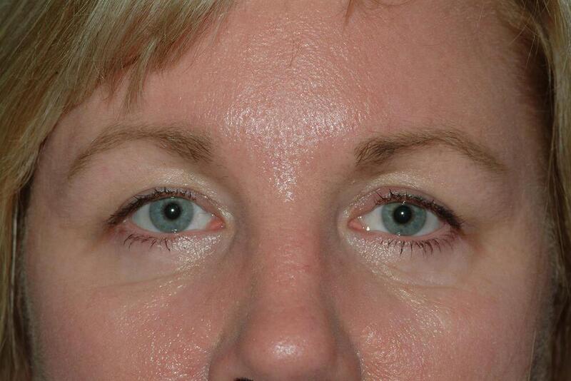 Brow Lift Before & After Image