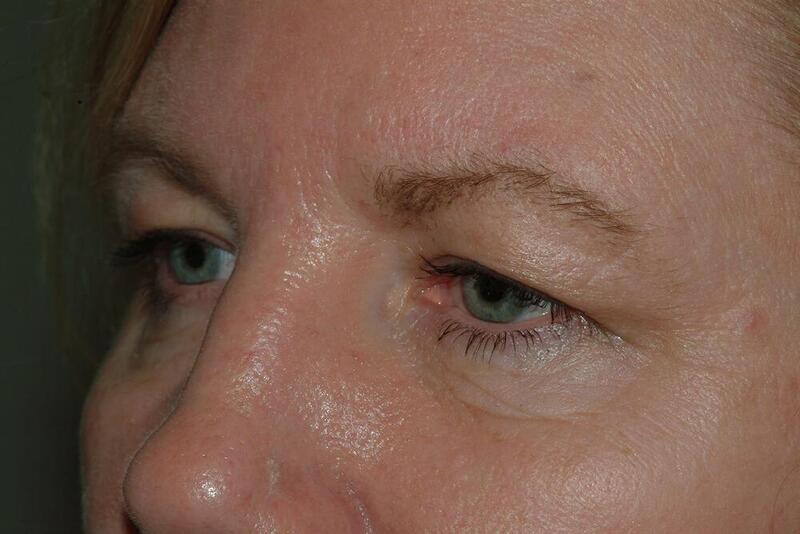 Brow Lift Before & After Image