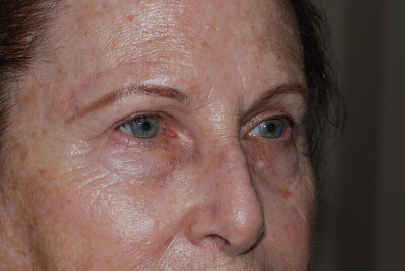 Brow Lift Before & After Image