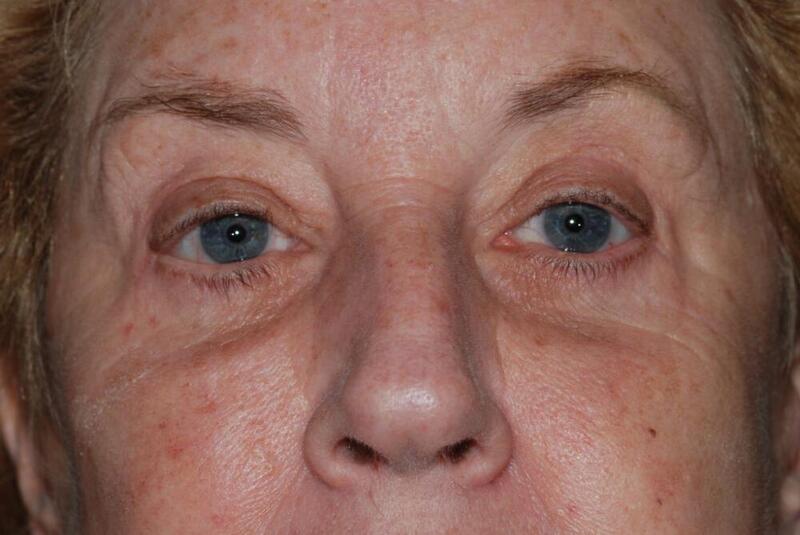 Brow Lift Before & After Image