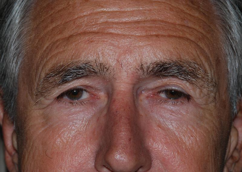 Brow Lift Before & After Image
