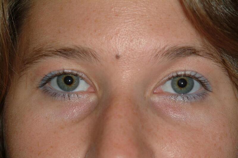 Brow Lift Before & After Image