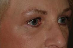 Brow Lift Before & After Image