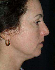 Chin Implant Before & After Image