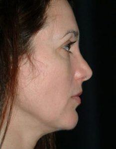 Chin Implant Before & After Image