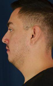 Chin Implant Before & After Image