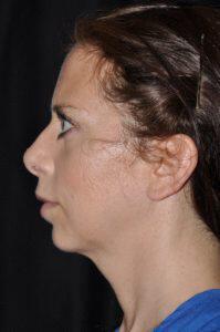 Chin Implant Before & After Image