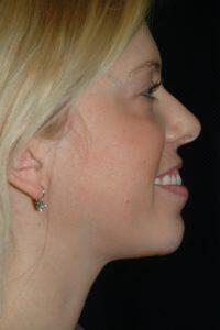 Chin Implant Before & After Image