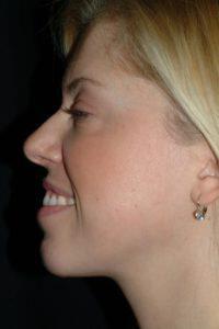 Chin Implant Before & After Image