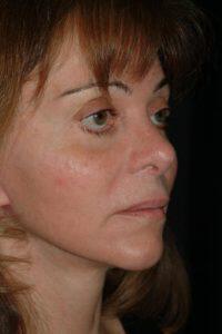 Chin Implant Before & After Image