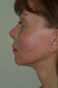 Chin Implant Before & After Image