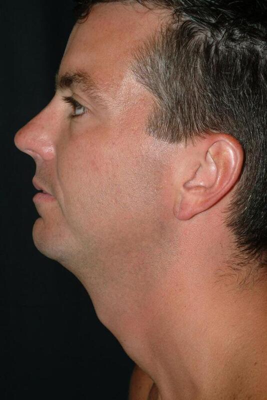 Chin Implant Before & After Image