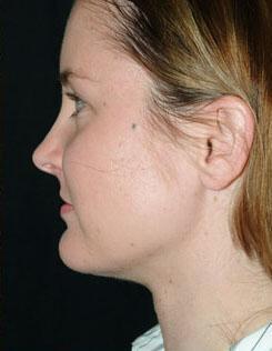 Chin & Neck Liposuction Before & After Image