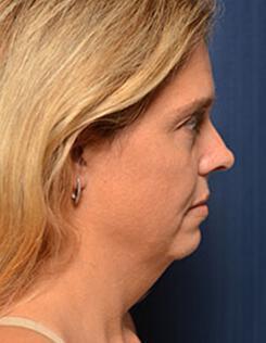 Chin & Neck Liposuction Before & After Image