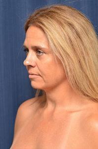 Chin & Neck Liposuction Before & After Image