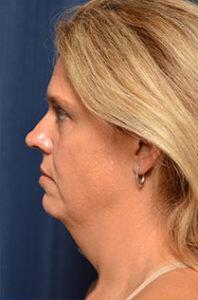 Chin & Neck Liposuction Before & After Image