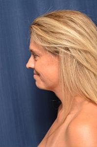 Chin & Neck Liposuction Before & After Image