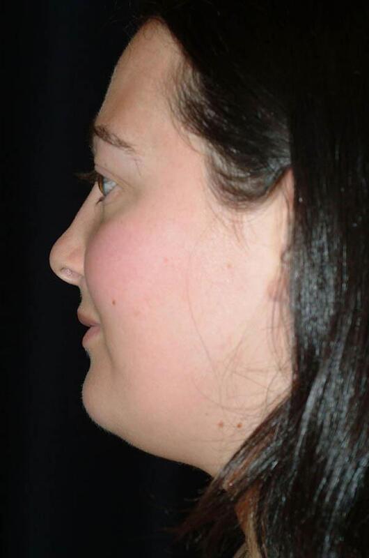 Chin & Neck Liposuction Before & After Image