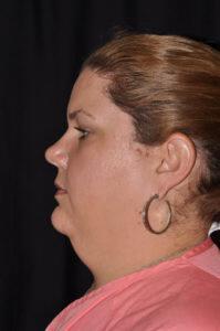 Chin & Neck Liposuction Before & After Image