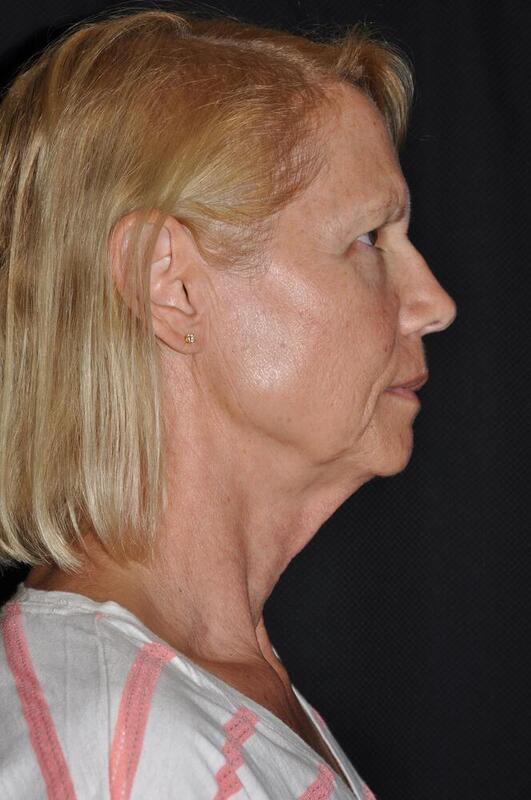 Facelift Before & After Image