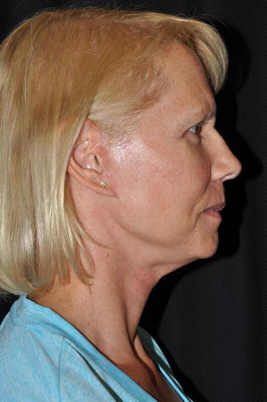 Facelift Before & After Image