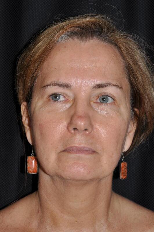 Facelift Before & After Image