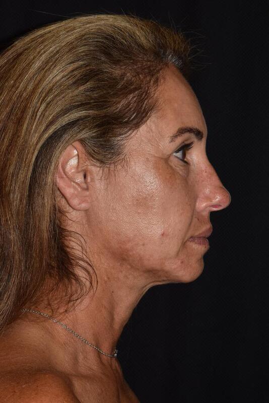 Facelift Before & After Image