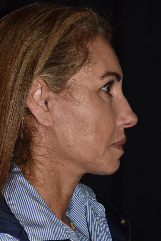 Facelift Before & After Image