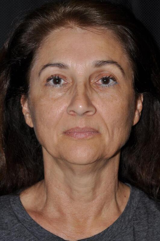 Facelift Before & After Image