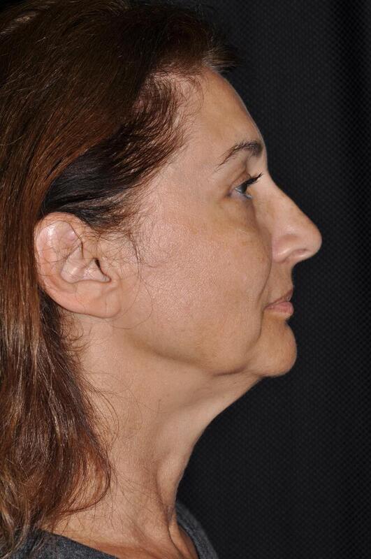 Facelift Before & After Image