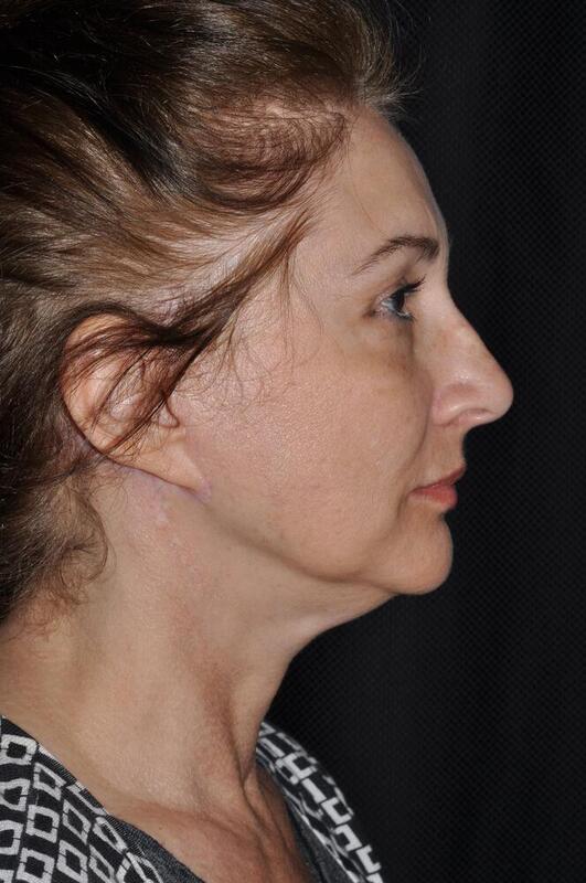 Facelift Before & After Image