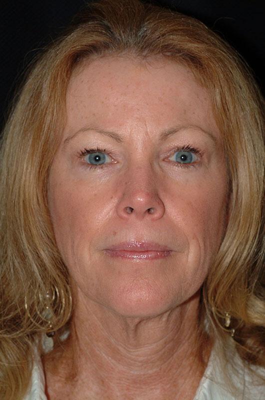 Facelift Before & After Image