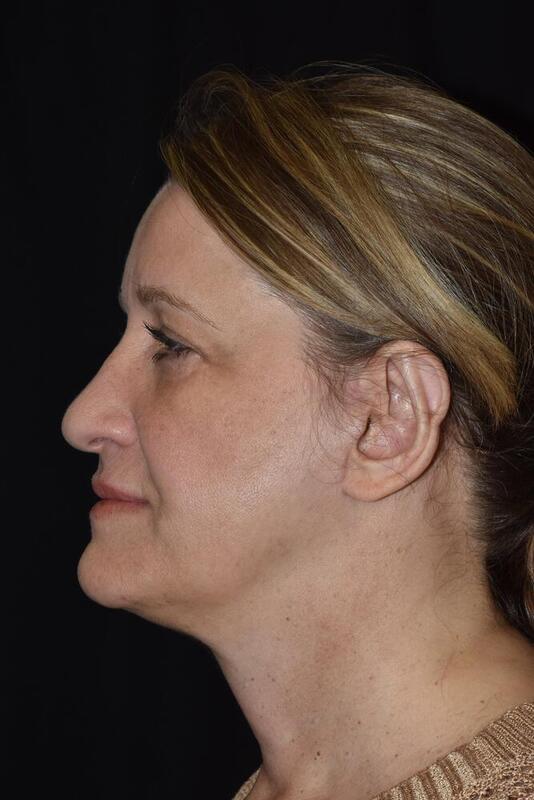 Facelift Before & After Image