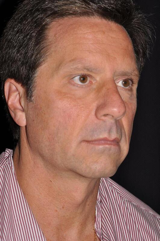 Facelift Before & After Image