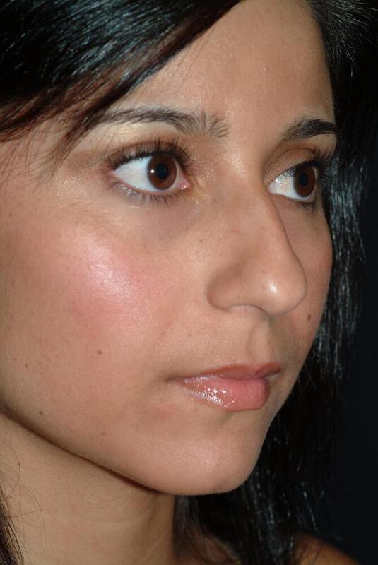 Rhinoplasty Before & After Image