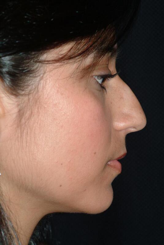 Rhinoplasty Before & After Image