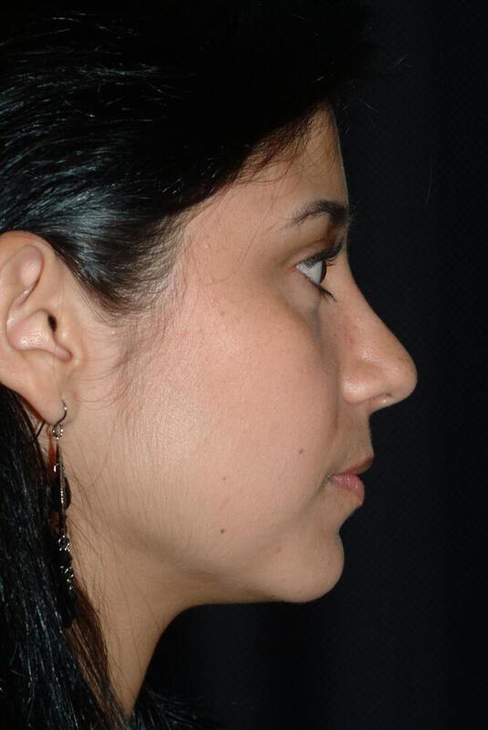 Rhinoplasty Before & After Image