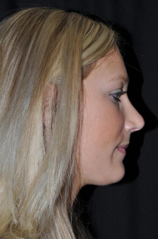 Rhinoplasty Before & After Image