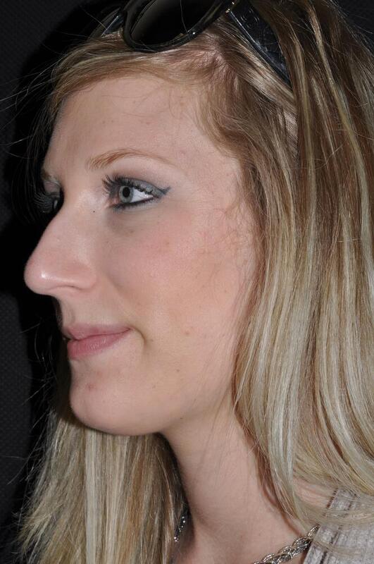 Rhinoplasty Before & After Image