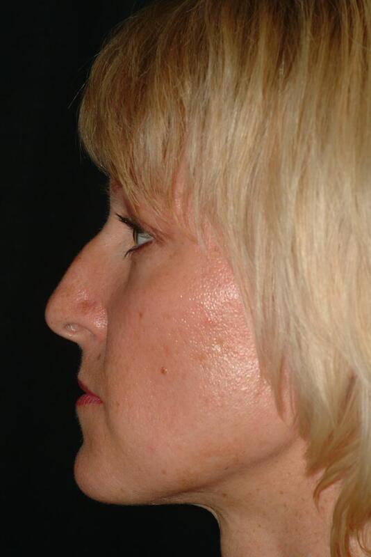 Rhinoplasty Before & After Image