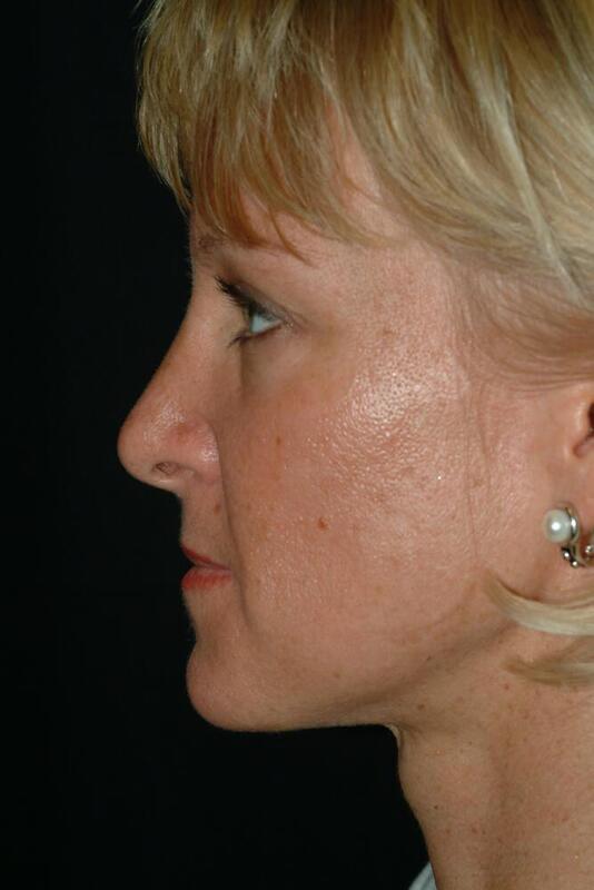 Rhinoplasty Before & After Image