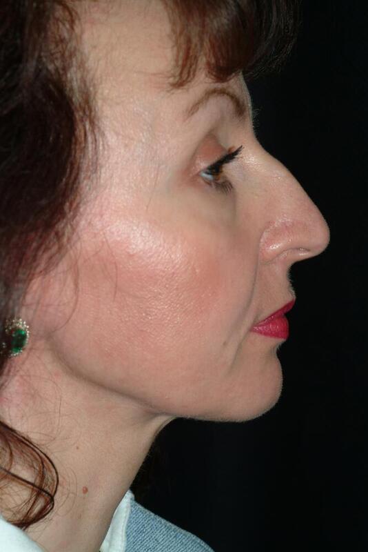 Rhinoplasty Before & After Image