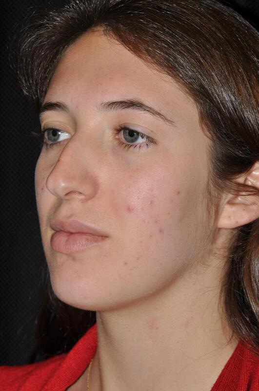 Rhinoplasty Before & After Image