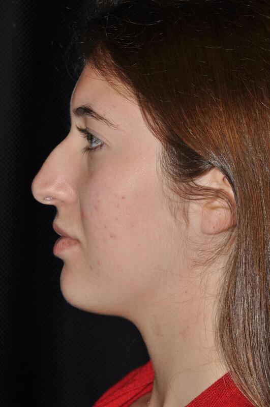 Rhinoplasty Before & After Image