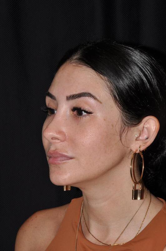 Rhinoplasty Before & After Image