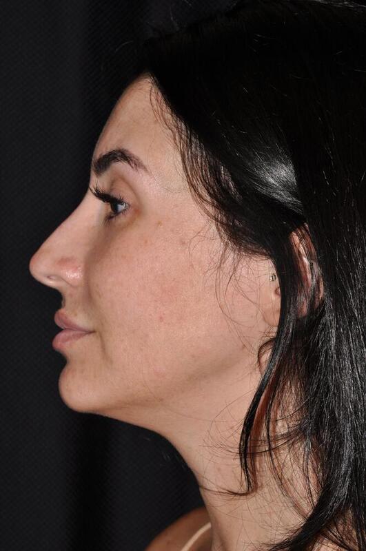 Rhinoplasty Before & After Image