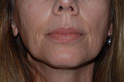 Dermal Fillers & Injectables Before & After Image