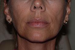 Dermal Fillers & Injectables Before & After Image