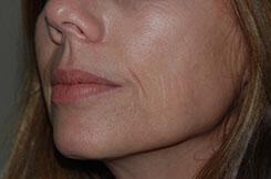 Dermal Fillers & Injectables Before & After Image